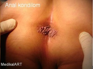 anal kondilom 300x223 Makat Siğili Tedavisi