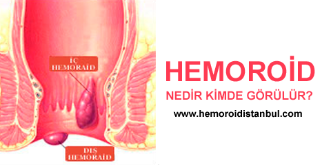 Hemoroid Nedir