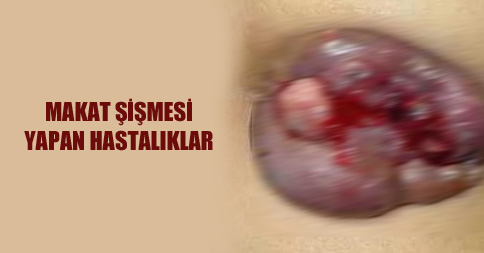 Makatta Şişlik